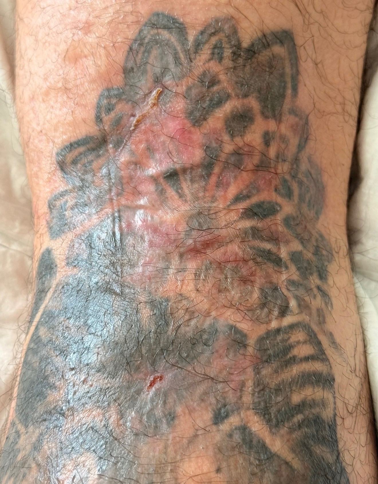 After 45 days: Healing skin with improved appearance and reduced visible discoloration
