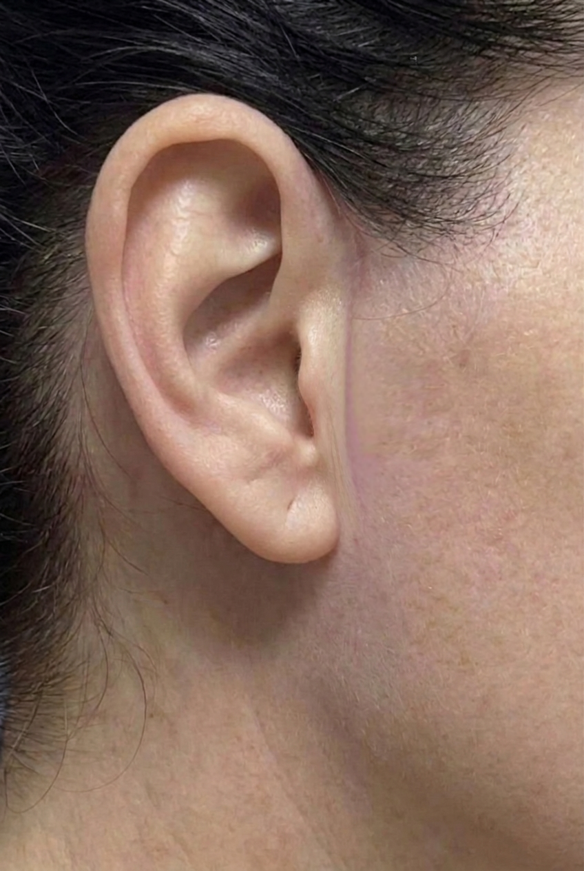 After 2 weeks: Settled post-surgical skin with reduced visible redness following deep plane facelift