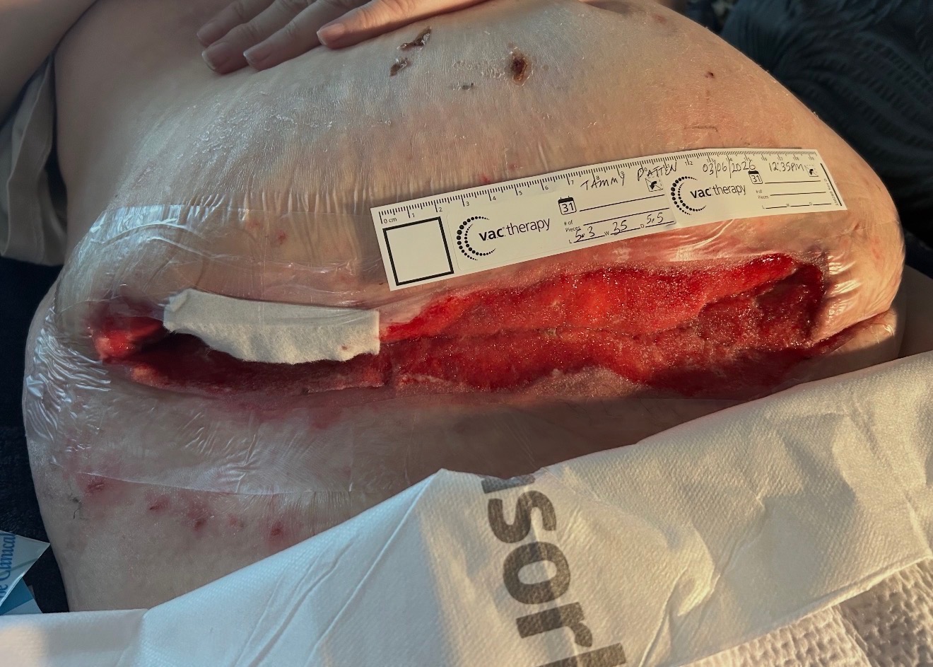 After 14 days: Healing skin with improved appearance following localized infection recovery