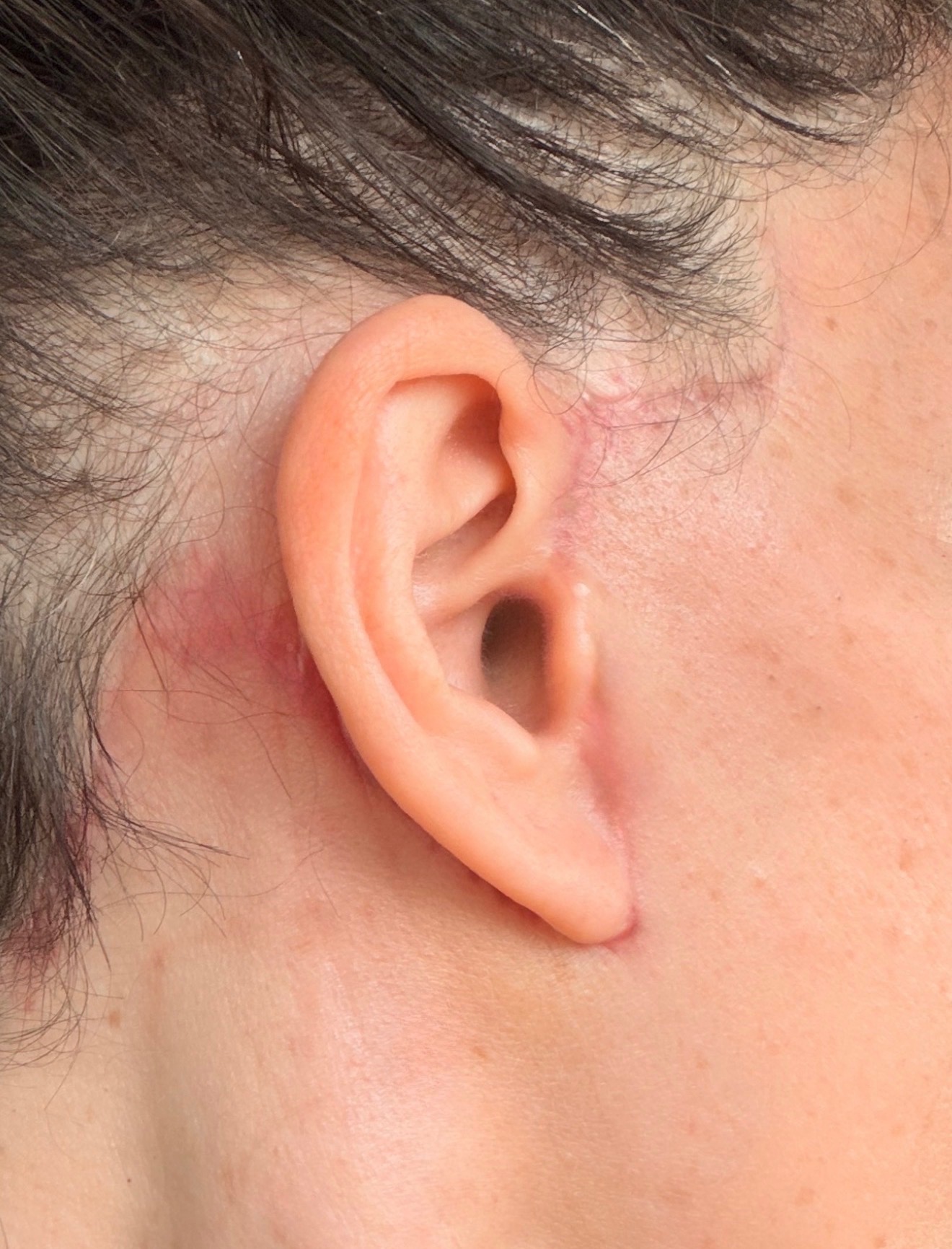 After 30 days: Well-settled post-surgical skin one month after deep plane facelift