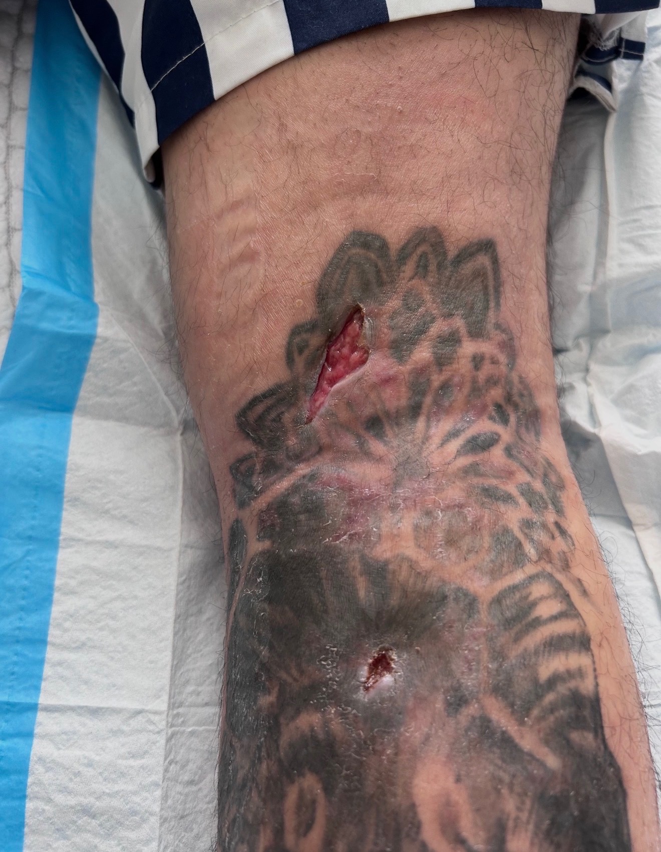 Before: Skin area affected by a spreading infection showing discoloration and irritation