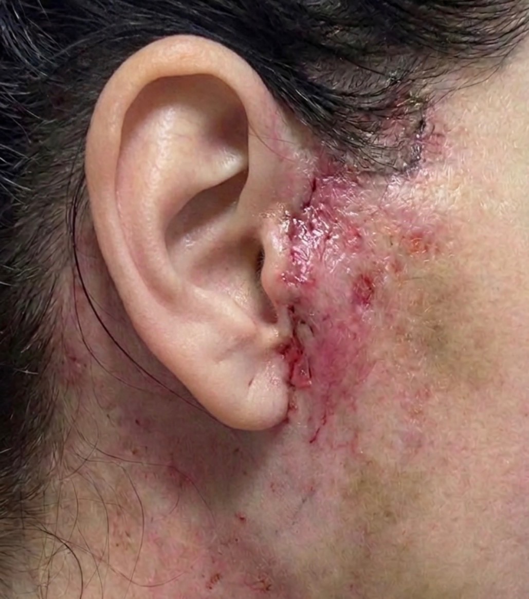 Before: Early post-surgical skin after deep plane facelift showing redness and swelling