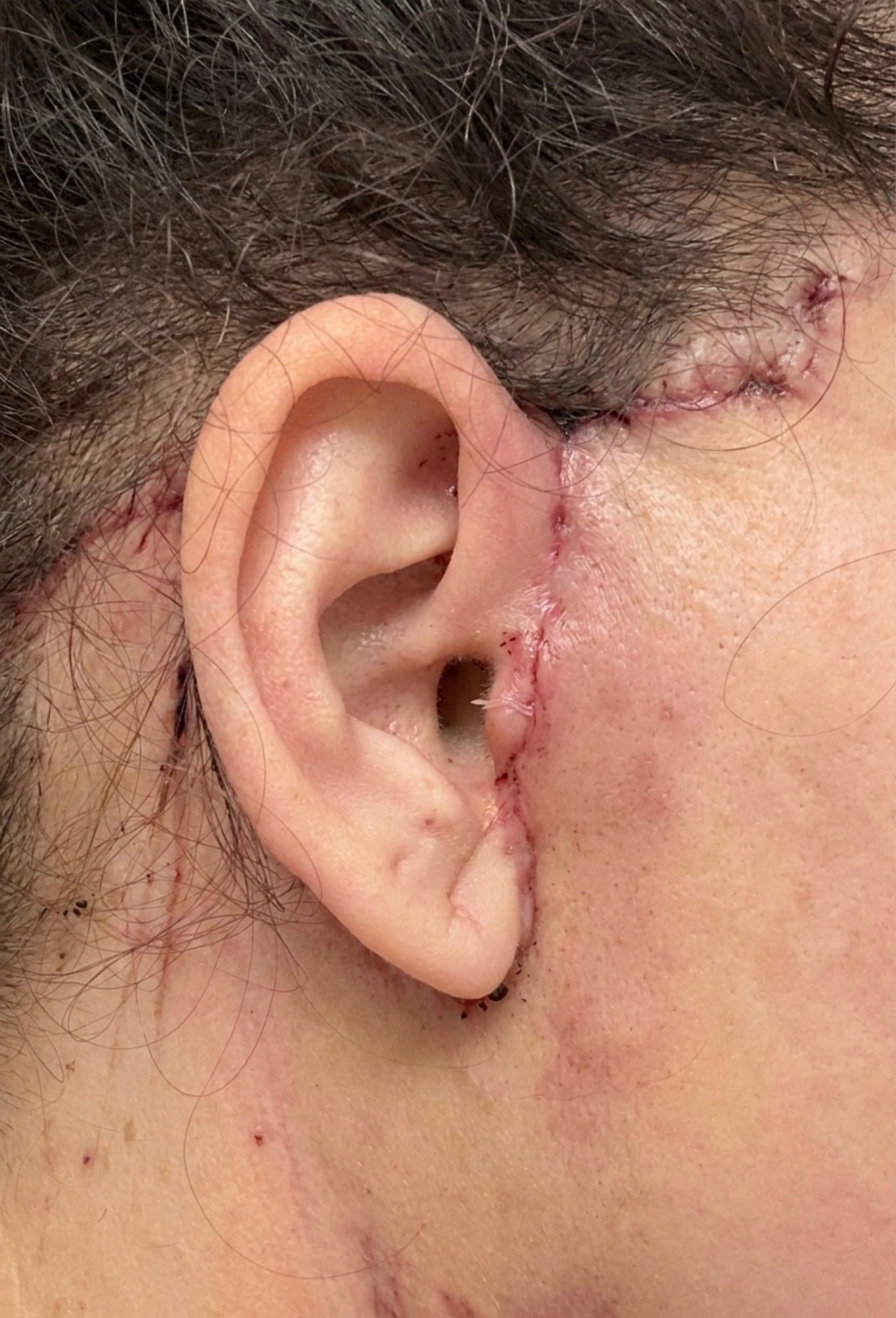 Before: Post-surgical skin after deep plane facelift showing redness and healing incision areas